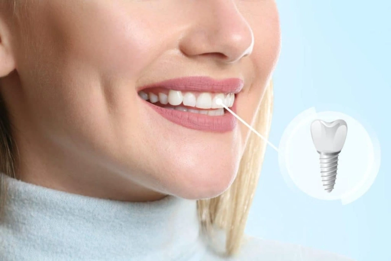 Dental Implants Searcy AR: A Permanent Solution for Your Perfect Smile