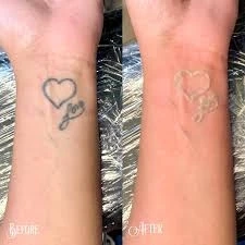 First Class Cosmetics removes exhausted colors by Tattoo removal NYC