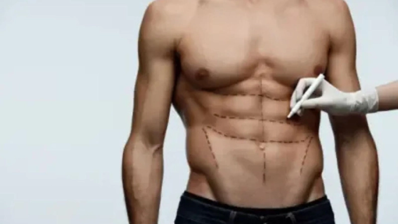 Expert Liposuction in Delhi – Sculpt India Clinic with Dr. Vivek Kumar