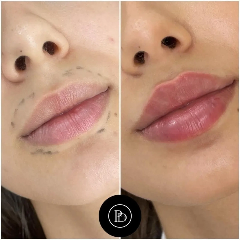 How Dermal Fillers Can Improve Your Smile: Expert Tips from the Best Doctors in Dubai