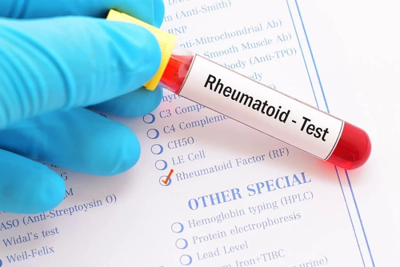 Rheumatoid arthritis: Overview, Blood tests and Complications