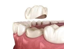 Tooth Cap Benefits: Stronger Bite, Less Pain