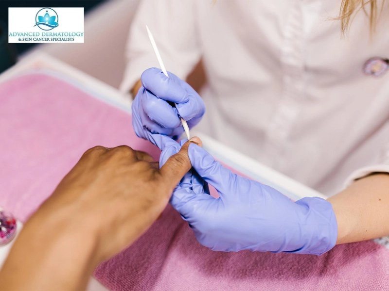 Is Fingernail Lifting a Sign of Infection or Just Nail Damage?