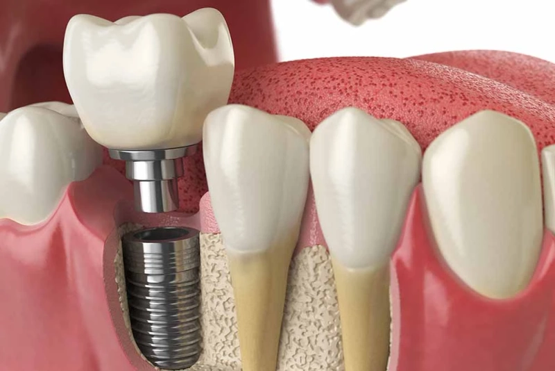Why dental implants cost more than other dentistry treatments?
