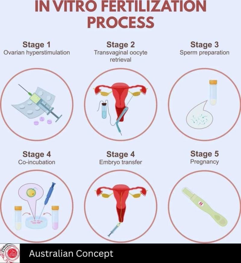 What are The 5 Stages of IVF and Its Process?