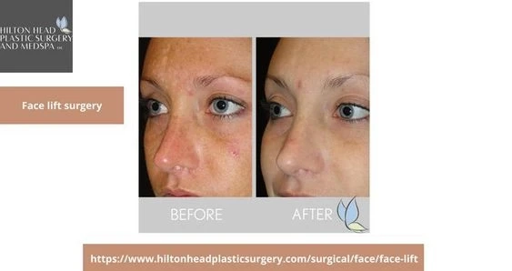 Detailed Information about a Safe Face Lift Surgery