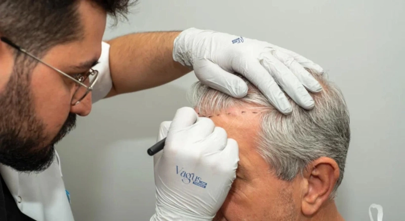FUE Hair Transplant Myths Busted: What You Should Know