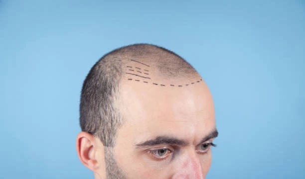 Top Hair Transplant Clinics in Riyadh: Where to Find the Best Treatment