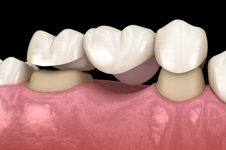 What To Expect Before And After Getting Dental Bridges