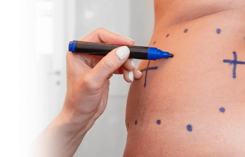 What is Liposuction Costs in Dubai UAE