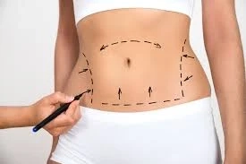 Is Liposuction Safe? - What to Expect, Risks, and Side Effects