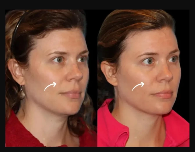Science Behind Sculptra Fillers in Dubai: How Poly-L-Lactic Acid Stimulates Collagen