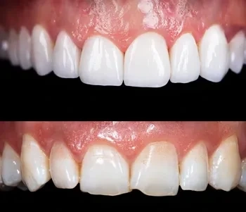 Facts About Teeth Whitening You Need To Know.