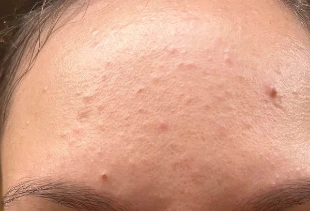 Oil Cleansing Method Ruined My Skin