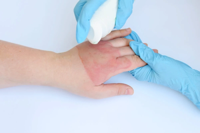 Burn Treatment Care Plans for Mild to Serious Burn Injuries