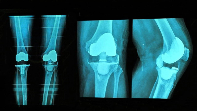 How Successful Are Knee Replacements?