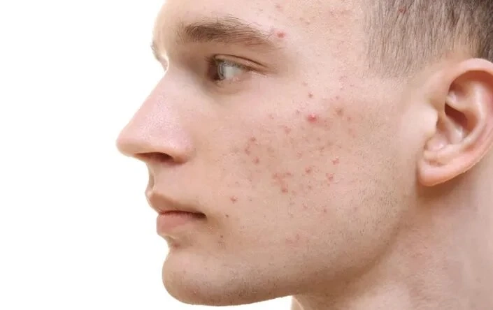 7 Reasons To Treat Acne Early