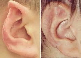 Cosmetic Ear Surgery Pin Back Your Ears