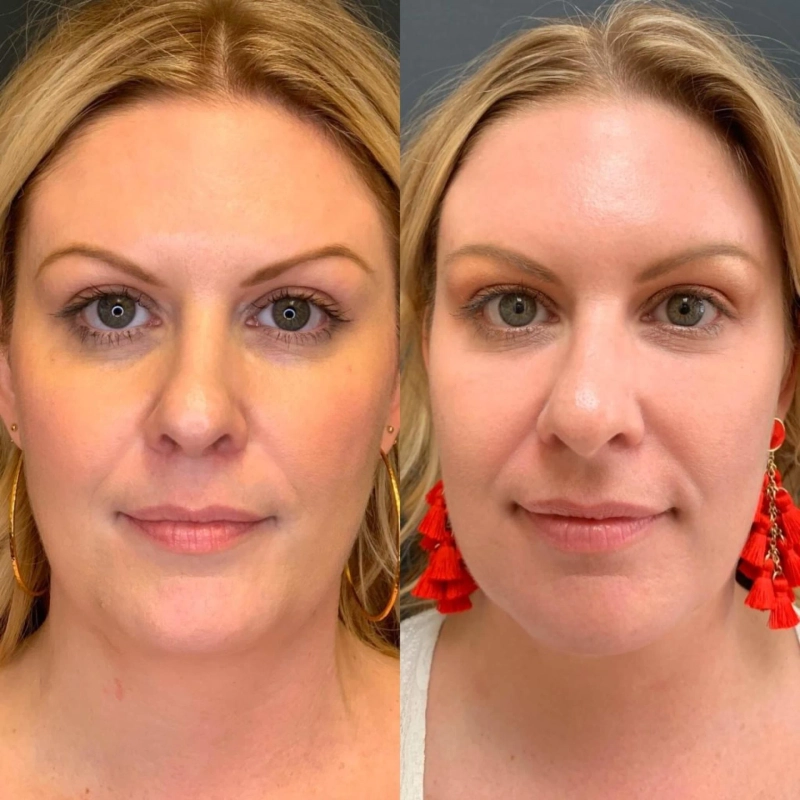 Unlocking Youthful Radiance: Plasma Injections for Facial Rejuvenation in Culpeper