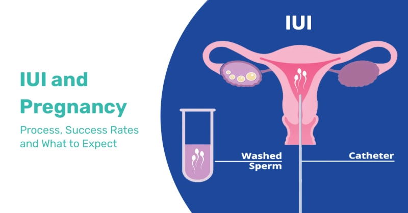 IUI and Pregnancy: Step-by-Step Process, Success Rates, and What to Expect 