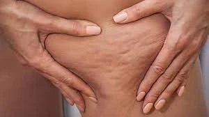 Bare Bliss: A New Era in Cellulite Removal