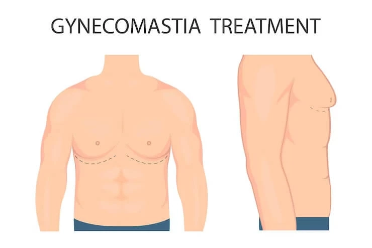 Thing you need to know about Gynecomastia Surgery – Stages, costs and types