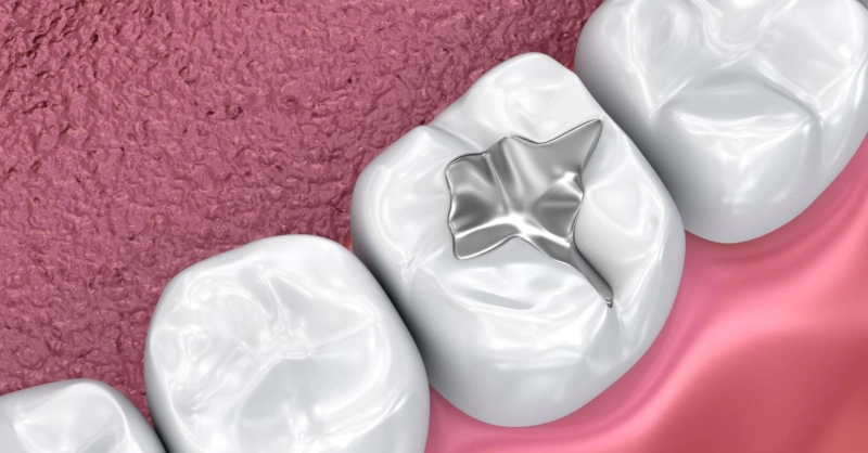 What are the ways that dental sealants help protect your teeth from tooth decay?