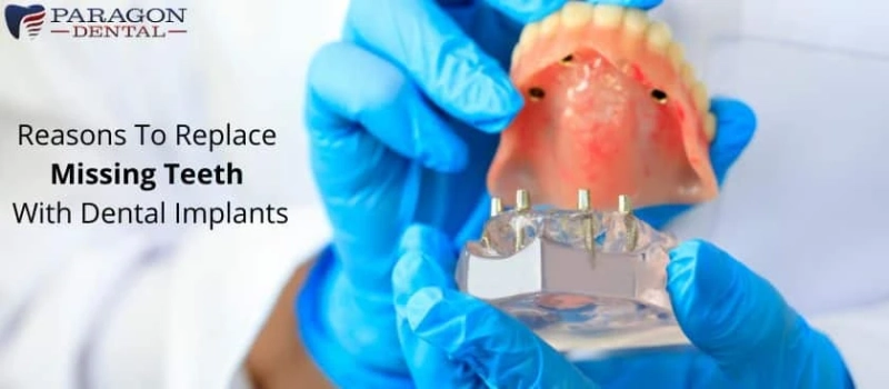 Reasons To Replace Missing Teeth With Dental Implants