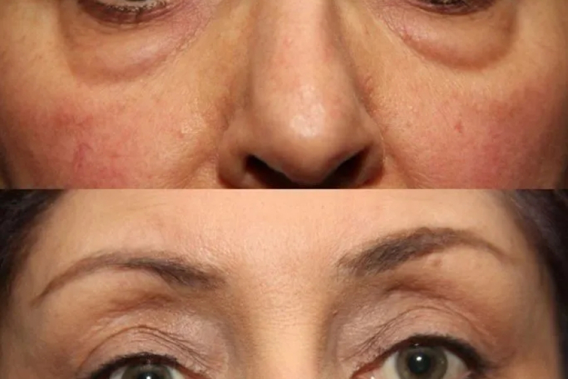 Deciding the Right Time for Blepharoplasty: A Comprehensive Guide