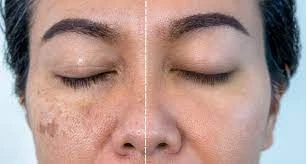 Melasma Treatment in Dubai: Achieving Clear and Radiant Skin