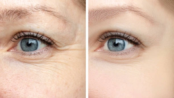 Botox and Fillers in Forest Hills: What You Need to Know Before Your First Appointment