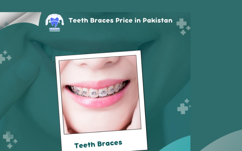 Unveiling Dental Costs in Pakistan: Your Comprehensive Guide to Braces, Implants, and More!