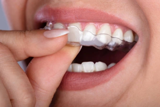 Discover the Clear Advantage: Why More Adults Are Turning to Invisalign