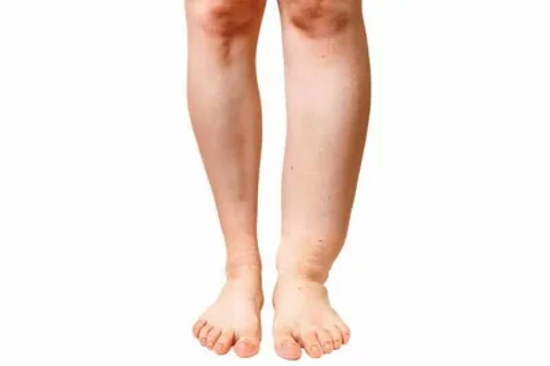 Filarisis Treatment: Navigating the Path to Recovery