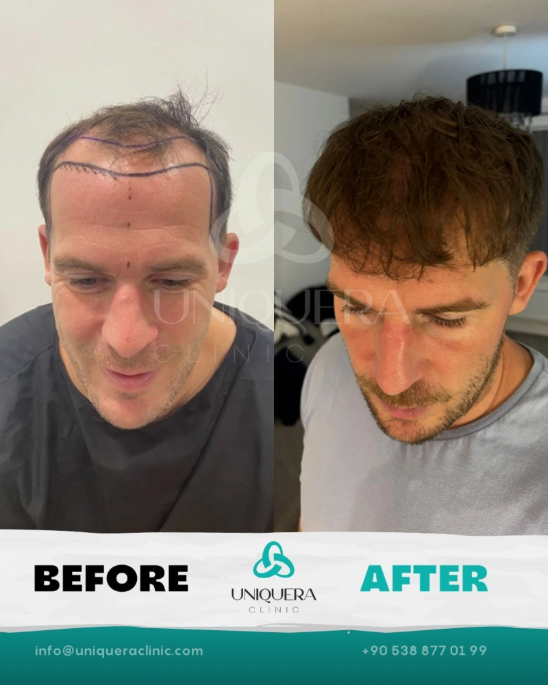 Is Hair Transplant in Turkey Safe? Risks and Smart Clinic Selection Guide
