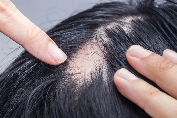 Discover the Advantages of Alopecia Areata Treatment in Pune