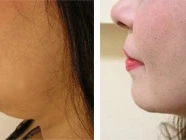 Best Chin Liposuction Clinics: Success Stories and Testimonials