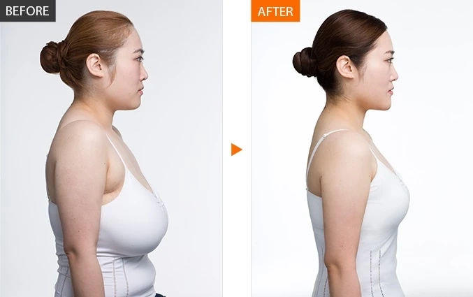 What are common breast implant problems?