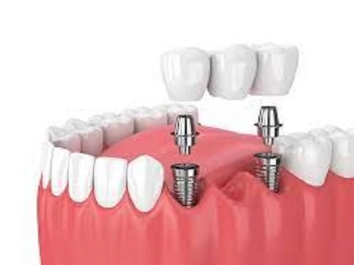 India Restorative Dentistry Market to be Dominated by Hospitals & Clinics Segment Through 2028