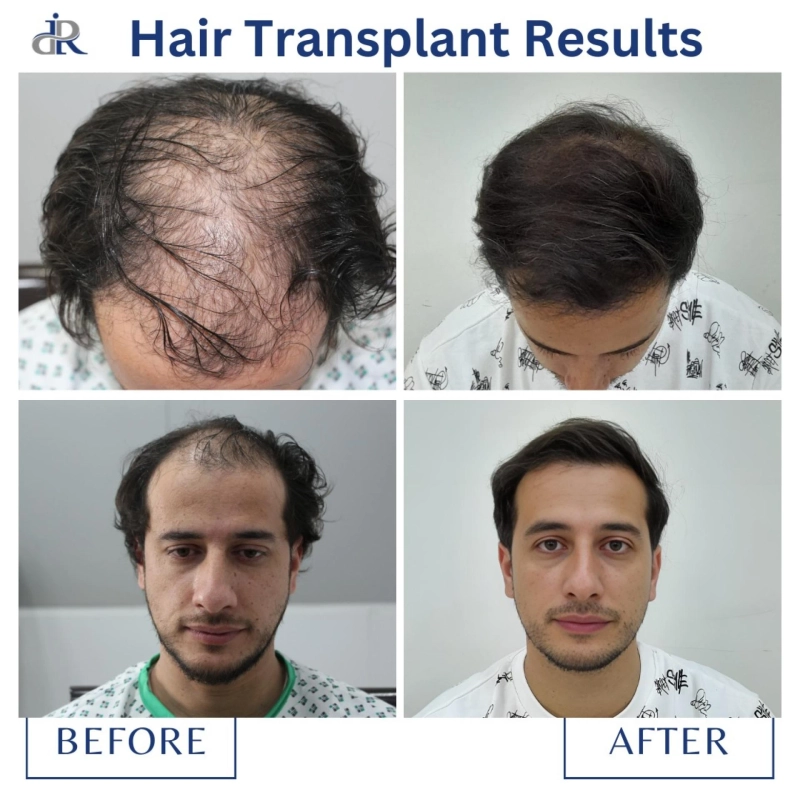 All About Hair Transplant Surgery: Expert Insights from a 20-Year Veteran