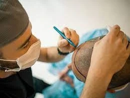 what is Hair Transplant treatment