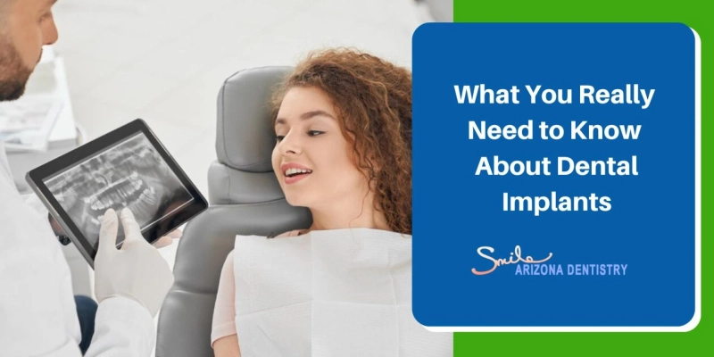 What You Really Need to Know About Dental Implants