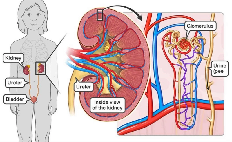 Navigating Glomerulonephritis Disease: Key Insights into Treatment and Diagnosis | DLI