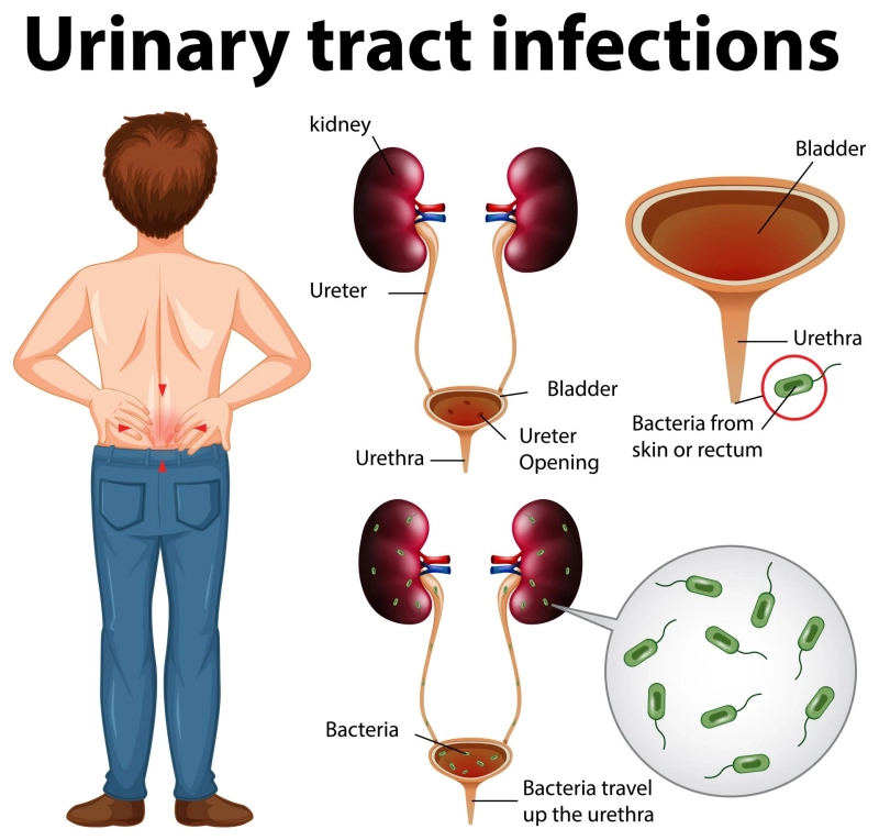 UTI vs. Bladder Infection: What’s the Difference and When to Seek Help?