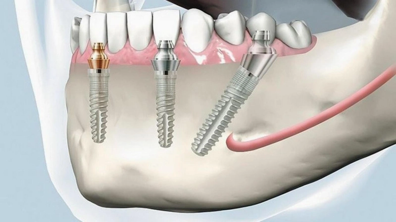 Bioresorbable Implants: The Future of Medical Devices