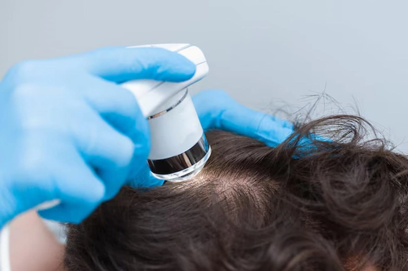 PRP Hair Loss Treatment in Birmingham Explained