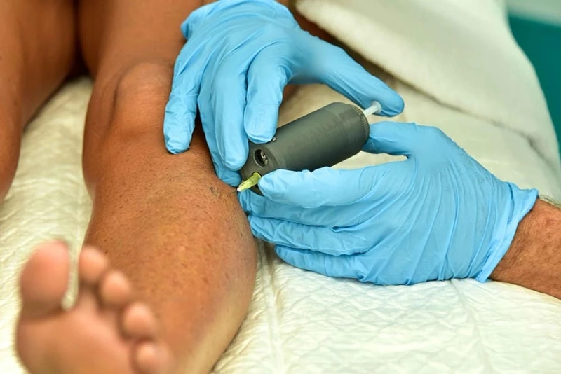 Find Out the Expert Advice on Varicose Veins 