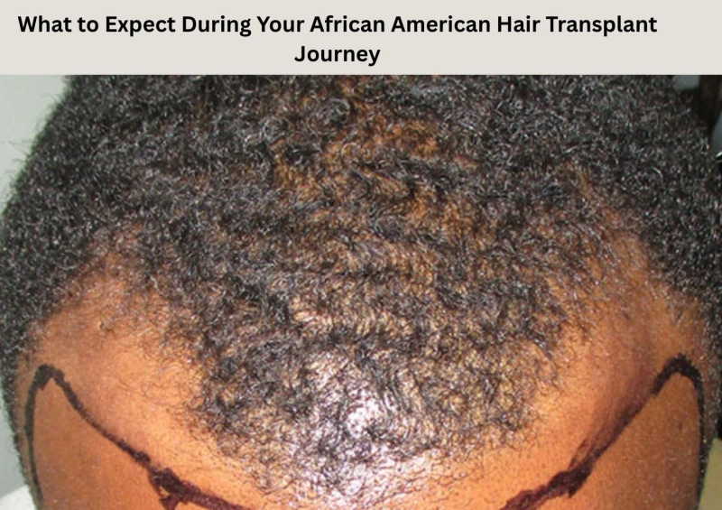 What to Expect During Your African American Hair Transplant Journey