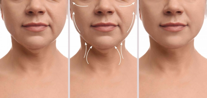 Understanding Neck Lift Surgery