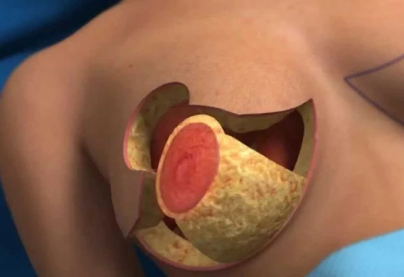 Are There Discounts or Special Offers for Breast Reduction?